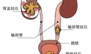 尿结石有哪些症状